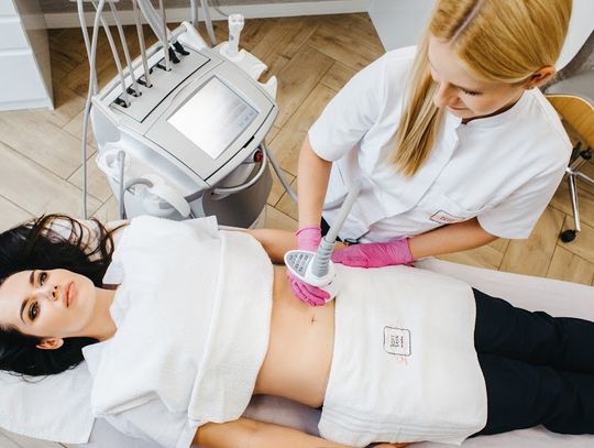 Usuwanie rozstępów - mezotetrapia NanoFrax i laseroterapia Fotona