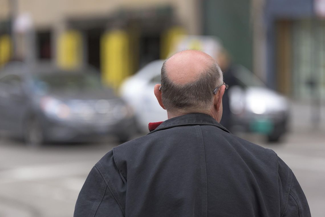 Dlaczego przerzedzanie włosów na czole u mężczyzn postępuje szybciej