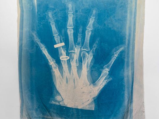 Joseph and Sarah Belknap_HAND-x-ray